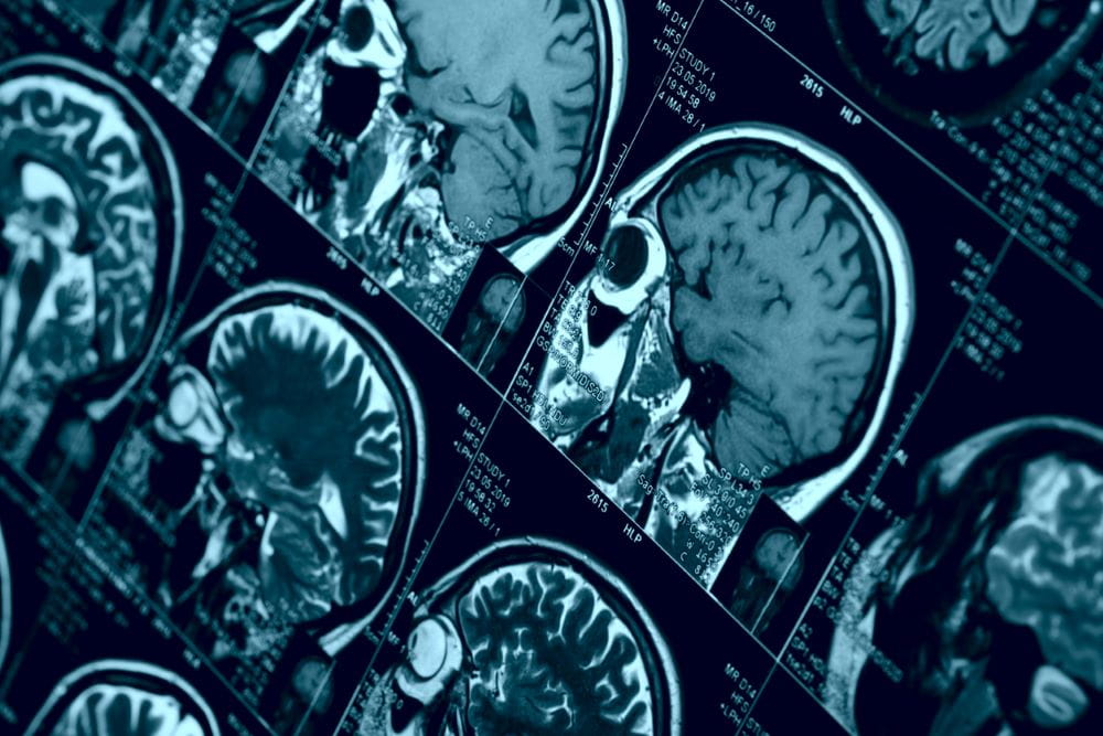 MRI scan of human brain, toned image.
